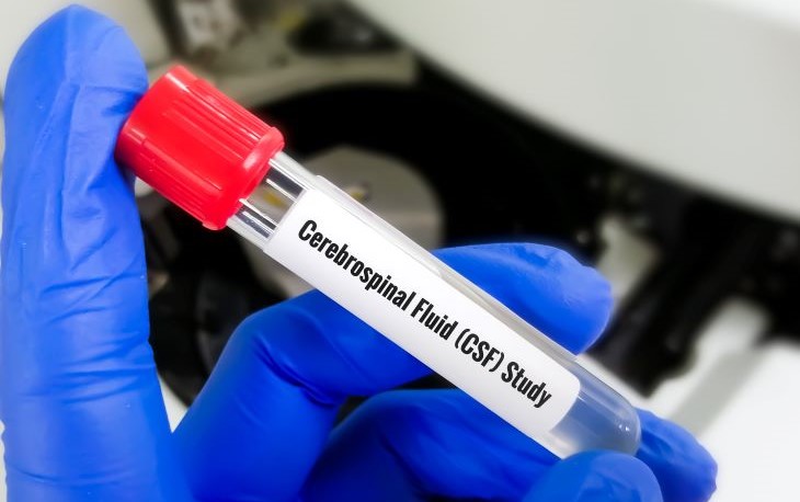 A gloved hand holds a test tube with a red top with the words &ldquo;Cerebrospinal Fluid.&rdquo;