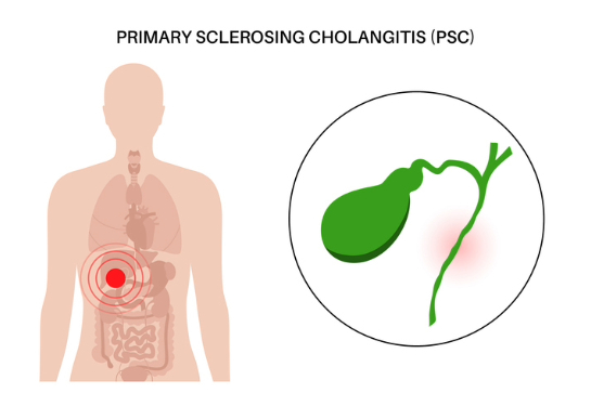 A diagram of the liver and bile ducts highlighting inflammation and scarring associated with primary sclerosing cholangitis.