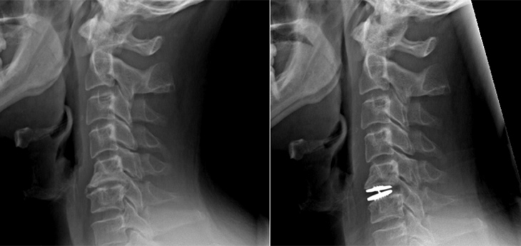 Two X-rays of Mark Bates&rsquo; neck before and after surgery.